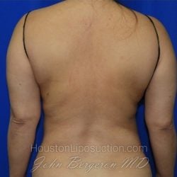 Liposuction after photo