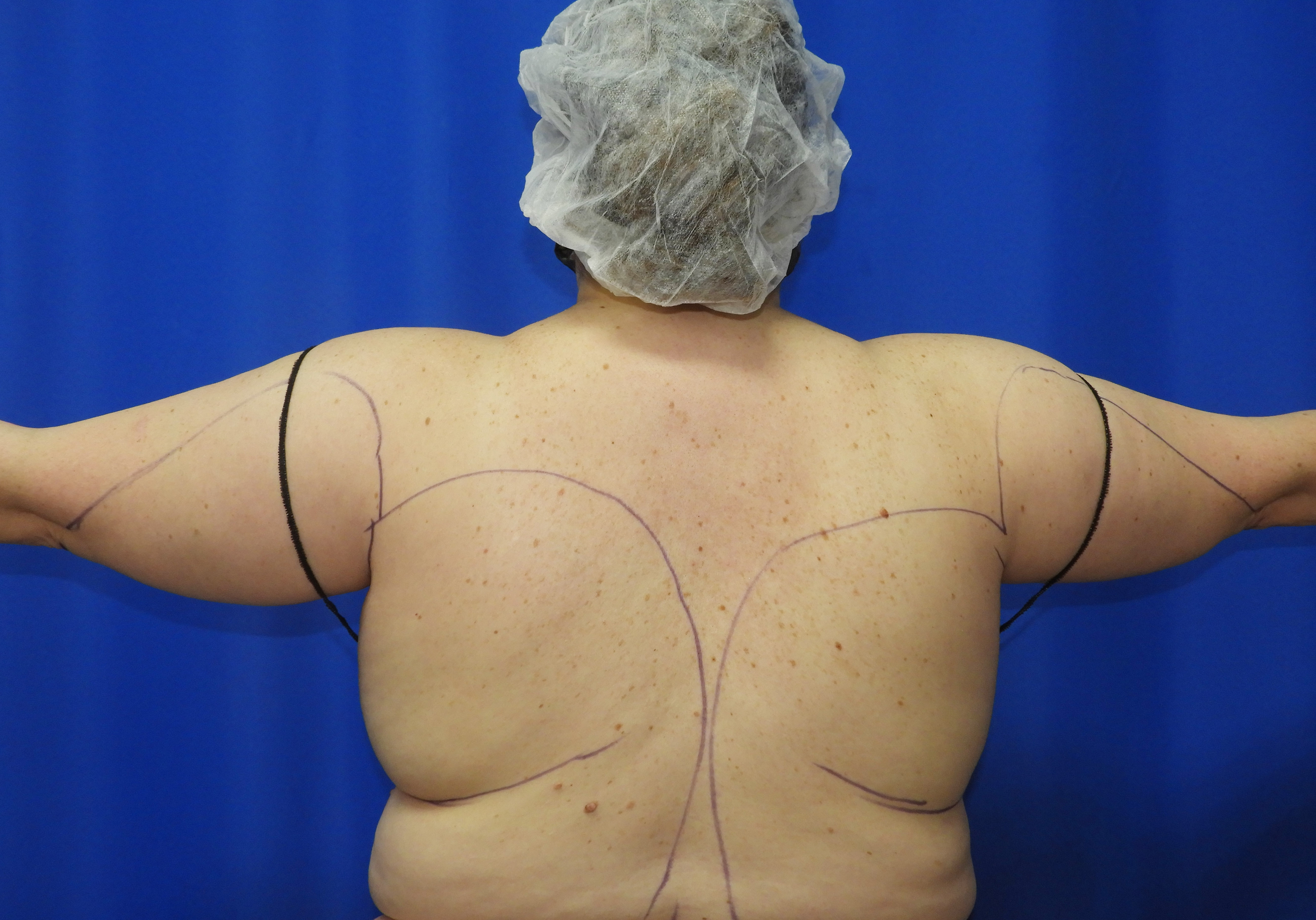 Liposuction before photo
