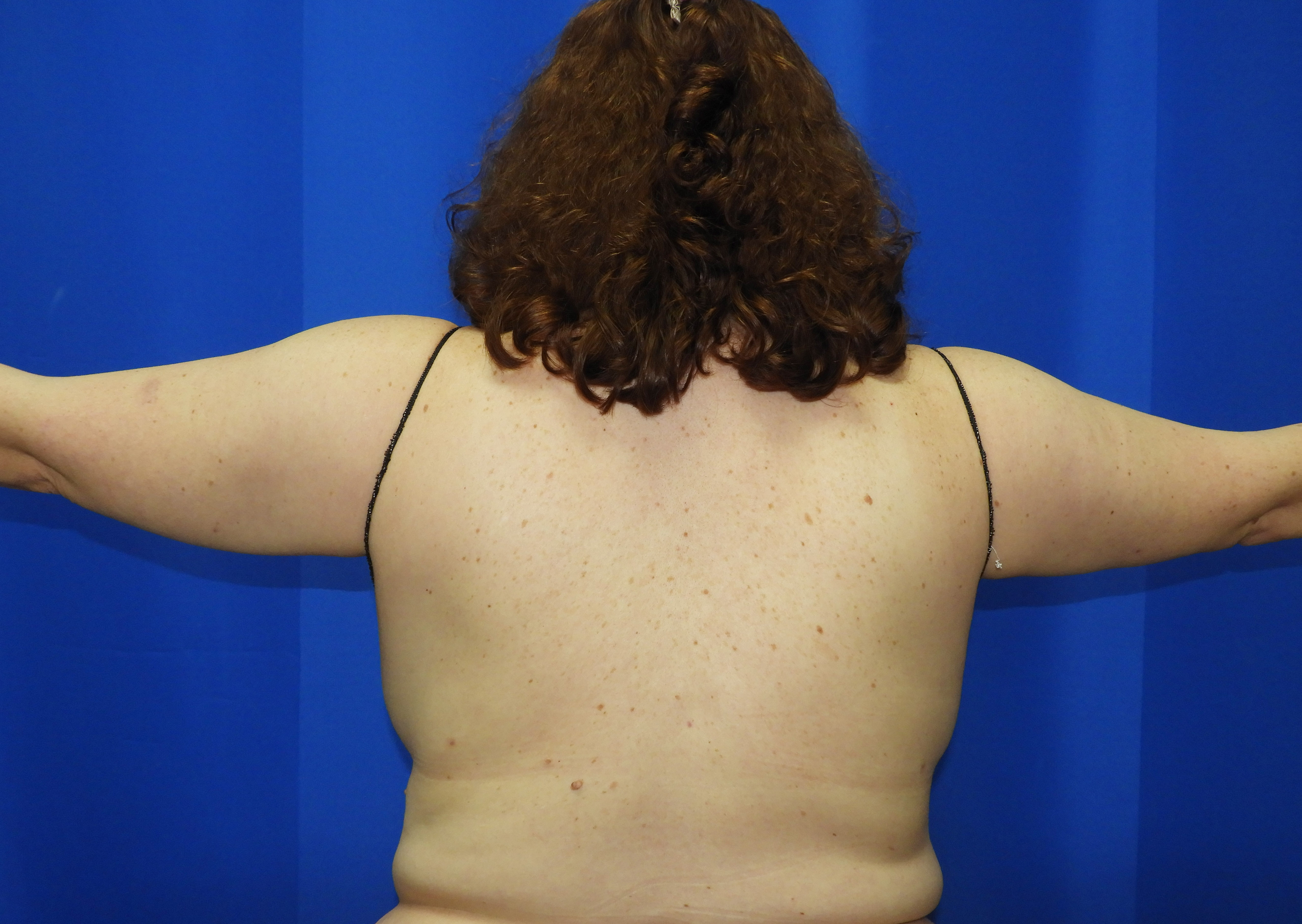 Liposuction after photo