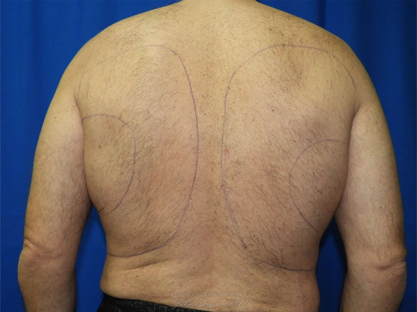 Liposuction before photo
