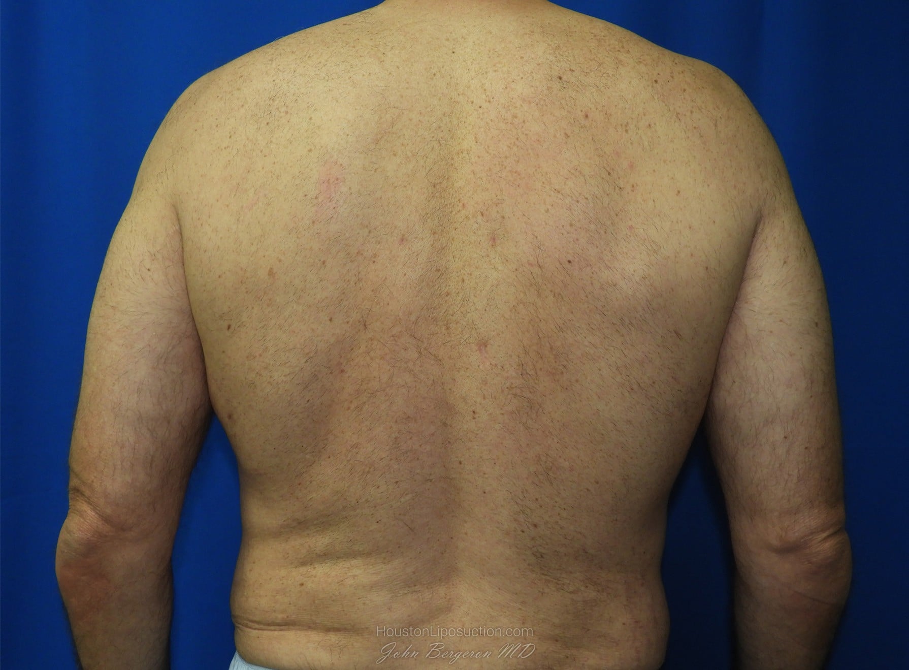 Liposuction after photo