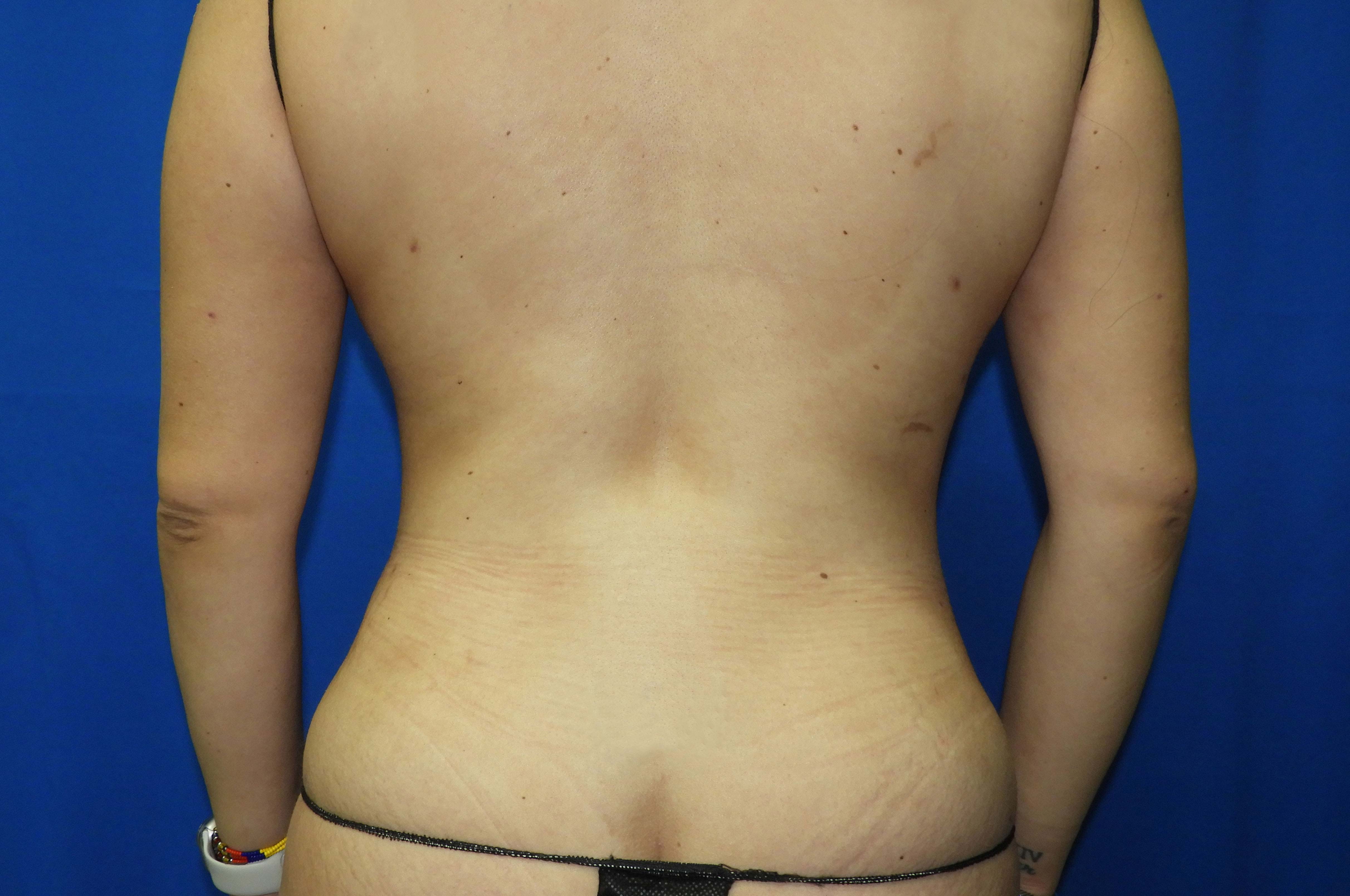 Liposuction after photo