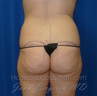 Liposuction before photo
