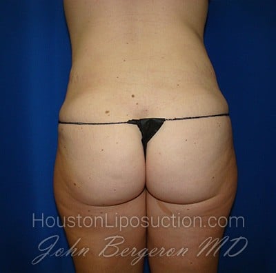 Liposuction after photo
