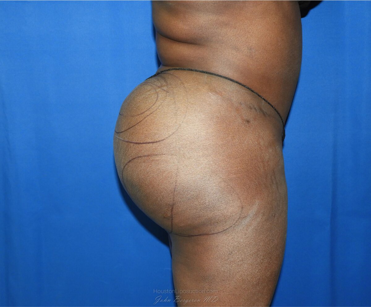 Liposuction before photo