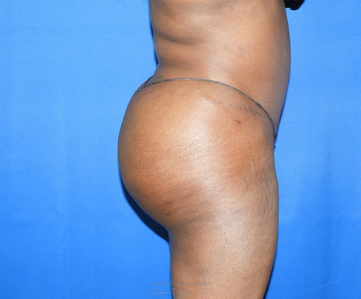 Liposuction after photo