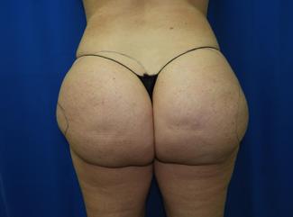 Liposuction before photo