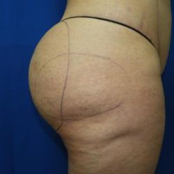 Liposuction before photo