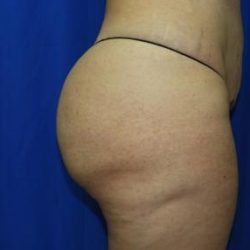 Liposuction after photo