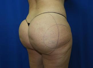 Liposuction before photo