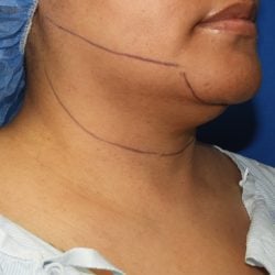 Liposuction before photo