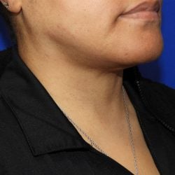 Liposuction after photo