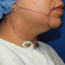 Liposuction before photo