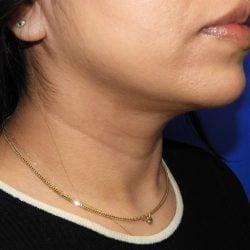 Liposuction after photo