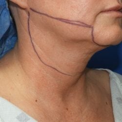 Liposuction before photo