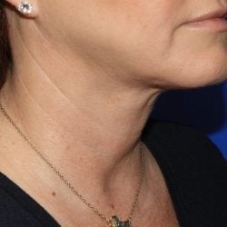 Liposuction after photo