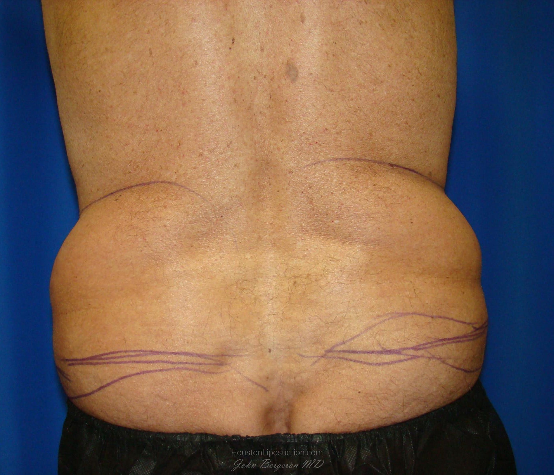 Liposuction before photo