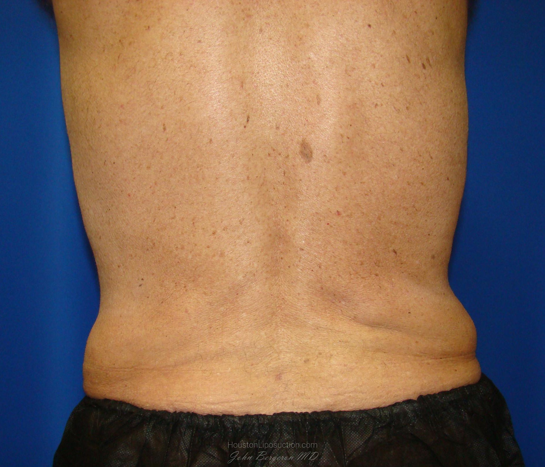 Liposuction after photo
