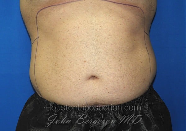 Liposuction before photo