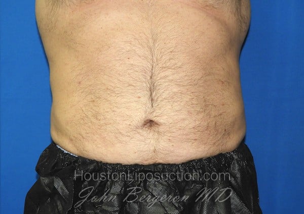 Liposuction after photo