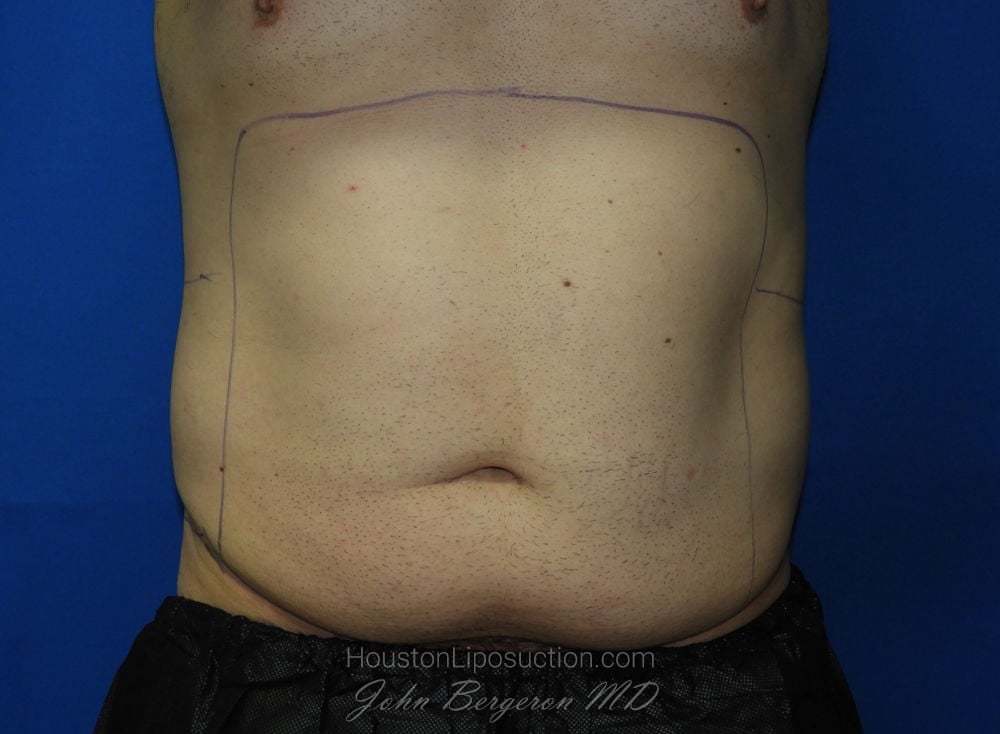 Liposuction before photo
