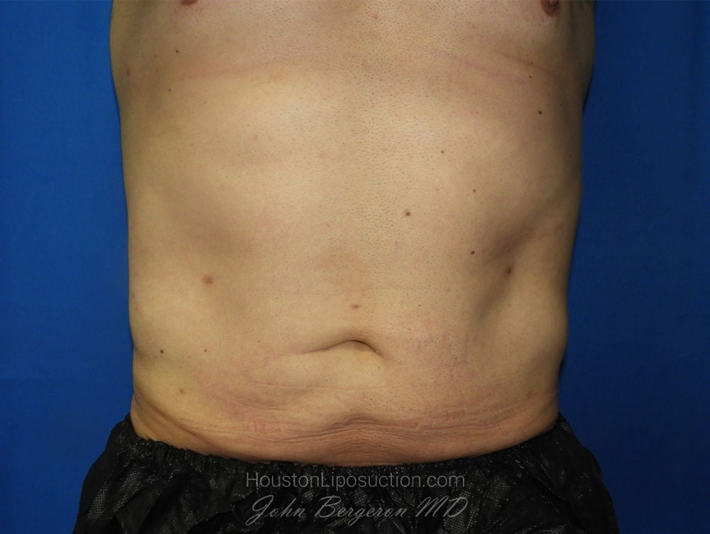 Liposuction after photo