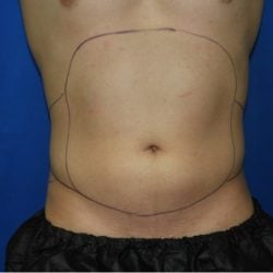 Liposuction before photo
