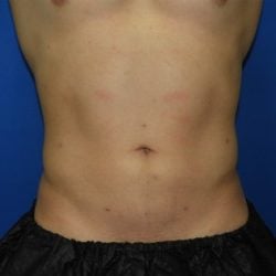 Liposuction after photo