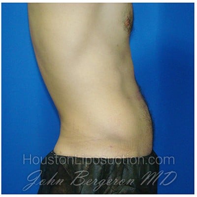 Liposuction after photo