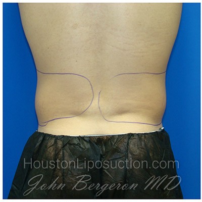 Liposuction before photo