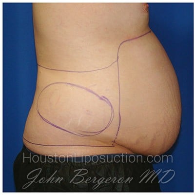 Liposuction before photo