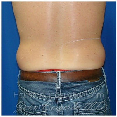 Liposuction before photo