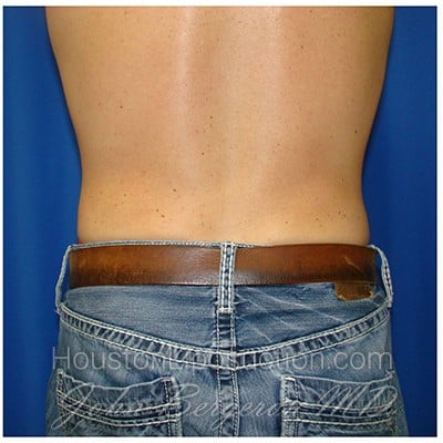 Liposuction after photo