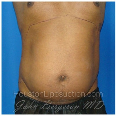 Liposuction before photo