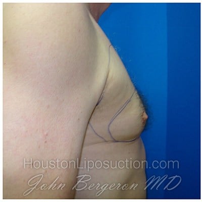 Liposuction before photo