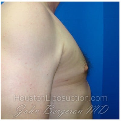 Liposuction after photo