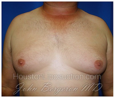 Liposuction before photo