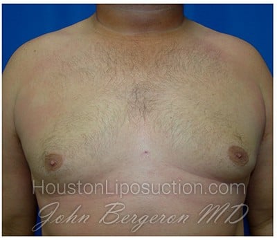Liposuction after photo