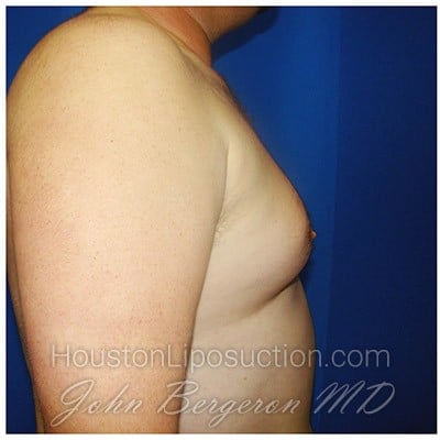 Liposuction before photo