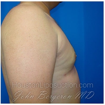 Liposuction after photo