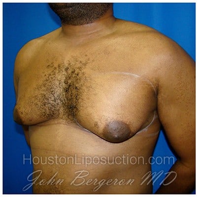Liposuction before photo