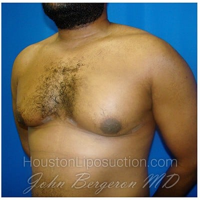Liposuction after photo