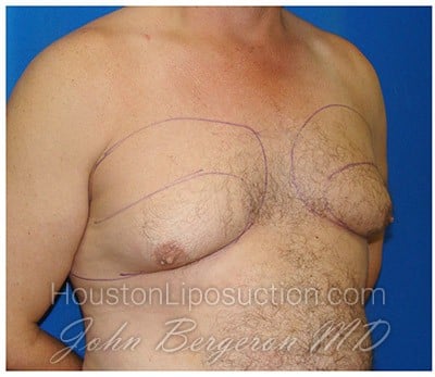 Liposuction before photo
