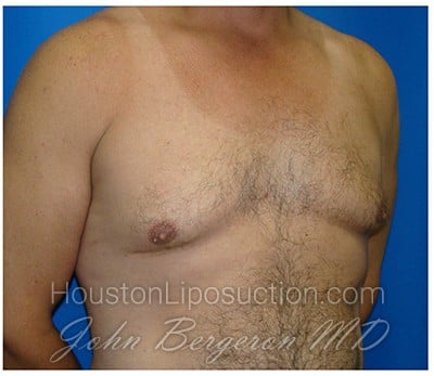 Liposuction after photo
