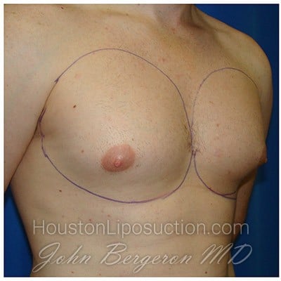 Liposuction before photo