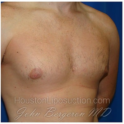 Liposuction after photo