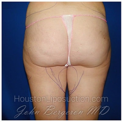 Liposuction before photo