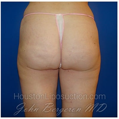 Liposuction after photo