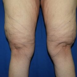 Liposuction before photo