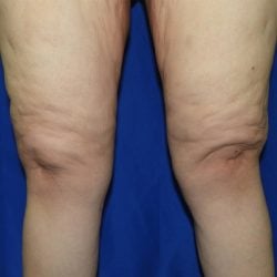 Liposuction after photo